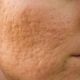 dhbelleza-estetica-avanzada-tratamiento-marcas-acne